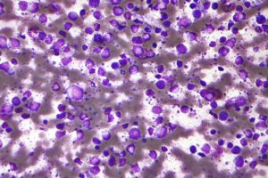 New Treatment Approved for Aggressive Blood Cancer Patients Nationwide