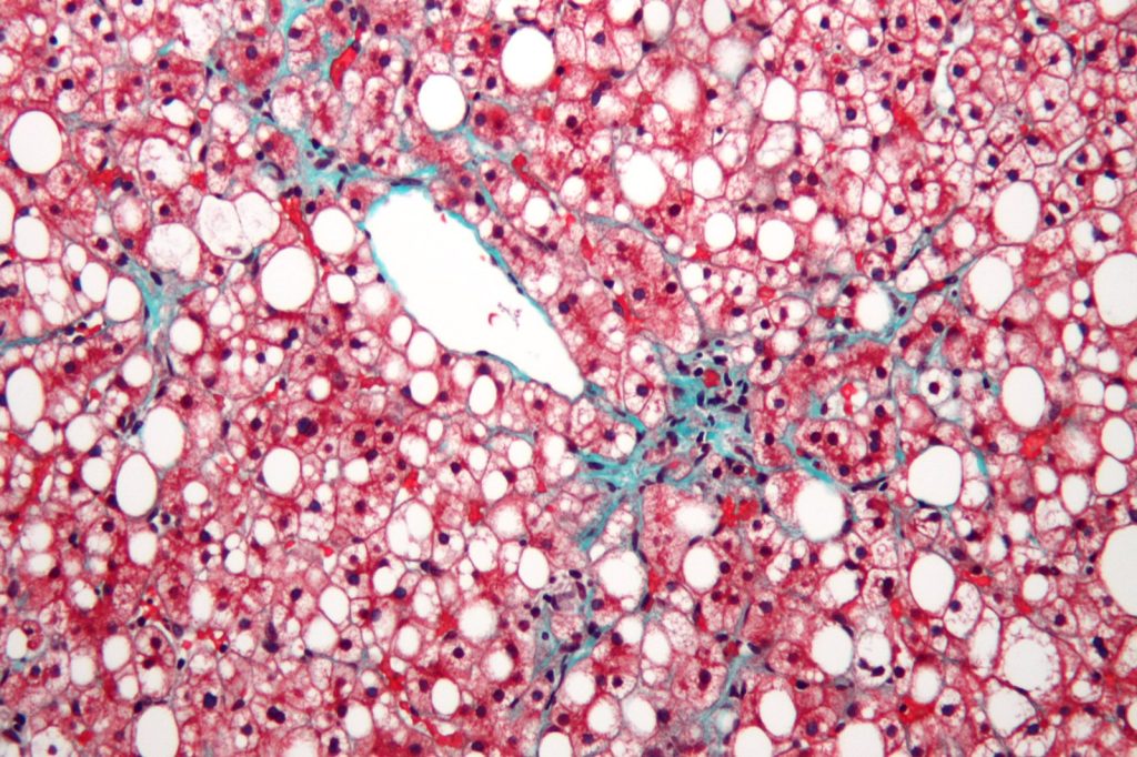 Global Liver Associations Adopt New Disease Naming Convention Effective Immediately