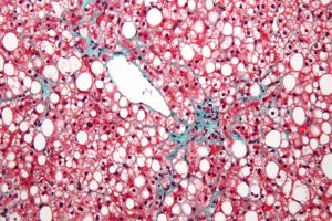 Global Liver Associations Adopt New Disease Naming Convention Effective Immediately