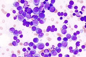 Talquetamab approved for multiple myeloma in US and EU