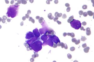 FDA Approves First-in-Class Tarlatamab for Aggressive Lung Cancer