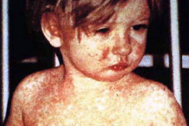 Hamilton child dies of measles; too young for full vaccine protection