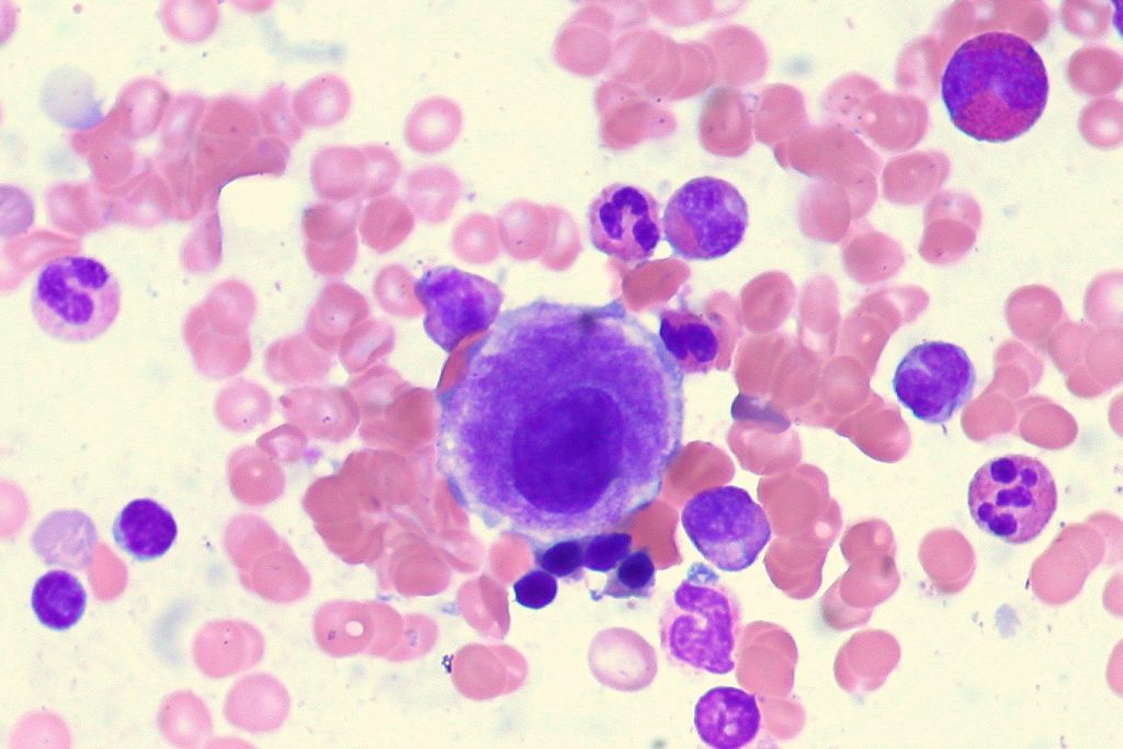 FDA Approves Imetelstat for Treating Myelodysplastic Syndromes with Anemia