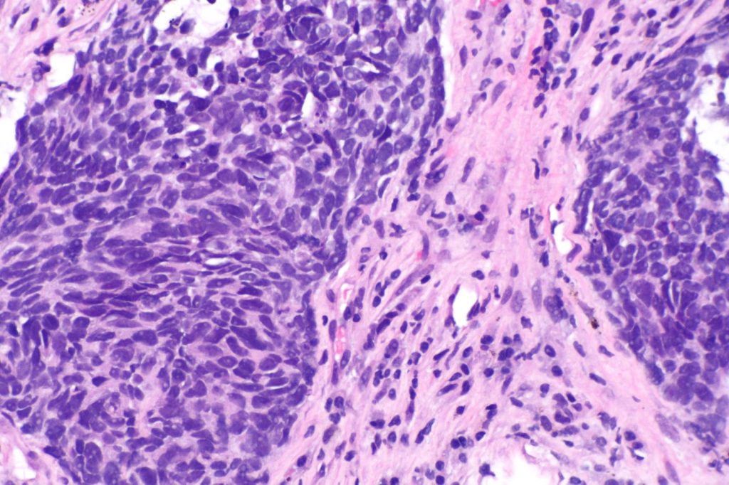 New Treatment Option Arrives for Non-Small Cell Lung Cancer Patients