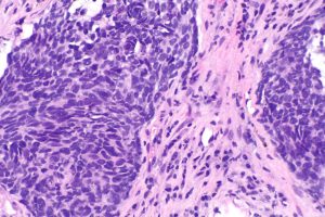 New Treatment Option Arrives for Non-Small Cell Lung Cancer Patients