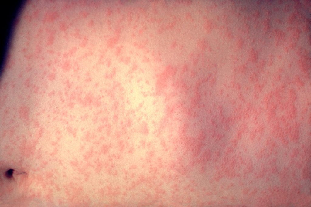 Texas Measles Outbreak Nears 150 Cases, Hospitalizes 20