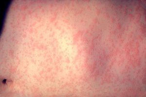 Texas Measles Outbreak Nears 150 Cases, Hospitalizes 20