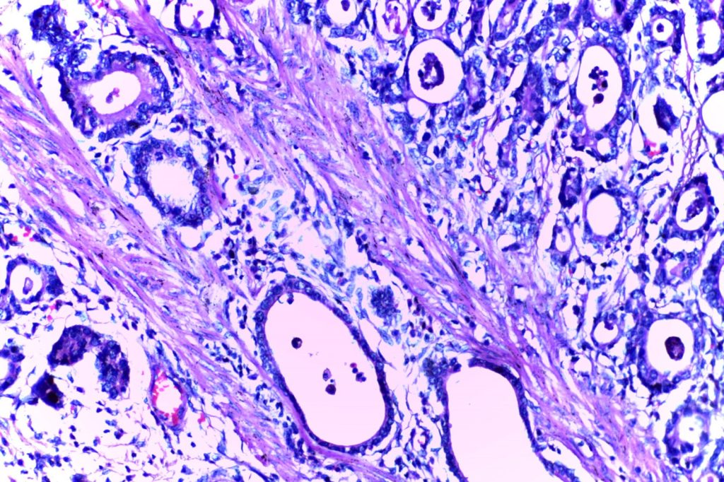 Stomach Cancer Decline Reverses as Under-50 Diagnosis Rates Rise