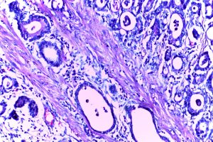 Stomach Cancer Decline Reverses as Under-50 Diagnosis Rates Rise