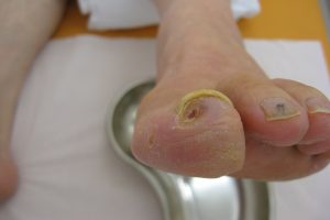 Toe Hair Loss Signals Circulation Issues, Doctor Says