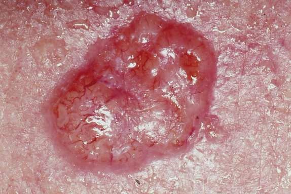 Study: 70% of Queenslanders sought skin cancer treatment over 8 years
