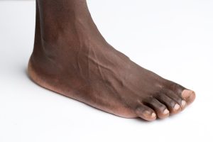 Runners’ Toe Hair Thinning Linked to Shoe Friction, Doctor Says