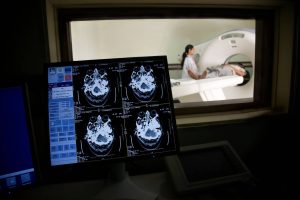 New Study Reveals Long, Silent Buildup of Brain Changes Before Dementia Onset