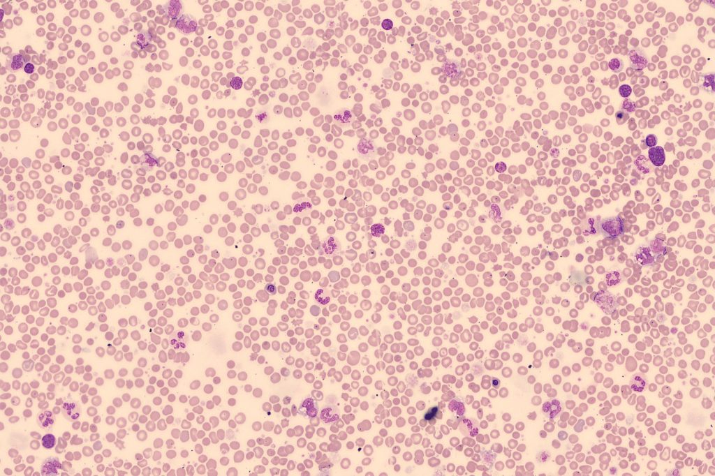 Ipsen targets myelofibrosis patients with ruxolitinib resistance in Phase III trial