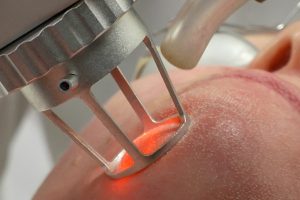 Study Finds 1940 nm Laser Light Alters Skin Cells’ Aging Process