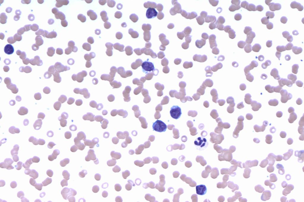 Lymphoma Research Foundation\u2019s 3.9 Million Targets Complex Disease