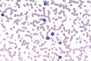 Lymphoma Research Foundation’s $3.9 Million Targets Complex Disease