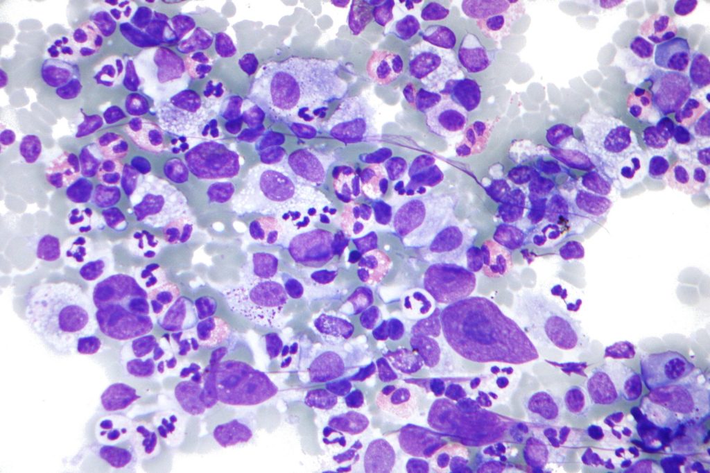 Lymphoma Research Foundation Grants Signal Open Questions in Field