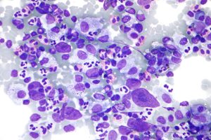 Lymphoma Research Foundation Grants Signal Open Questions in Field