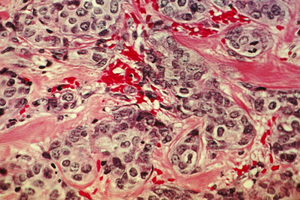 Genes controlling cell adhesion linked to breast cancer spread risk