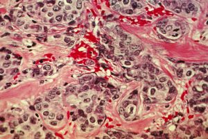 Genes controlling cell adhesion linked to breast cancer spread risk