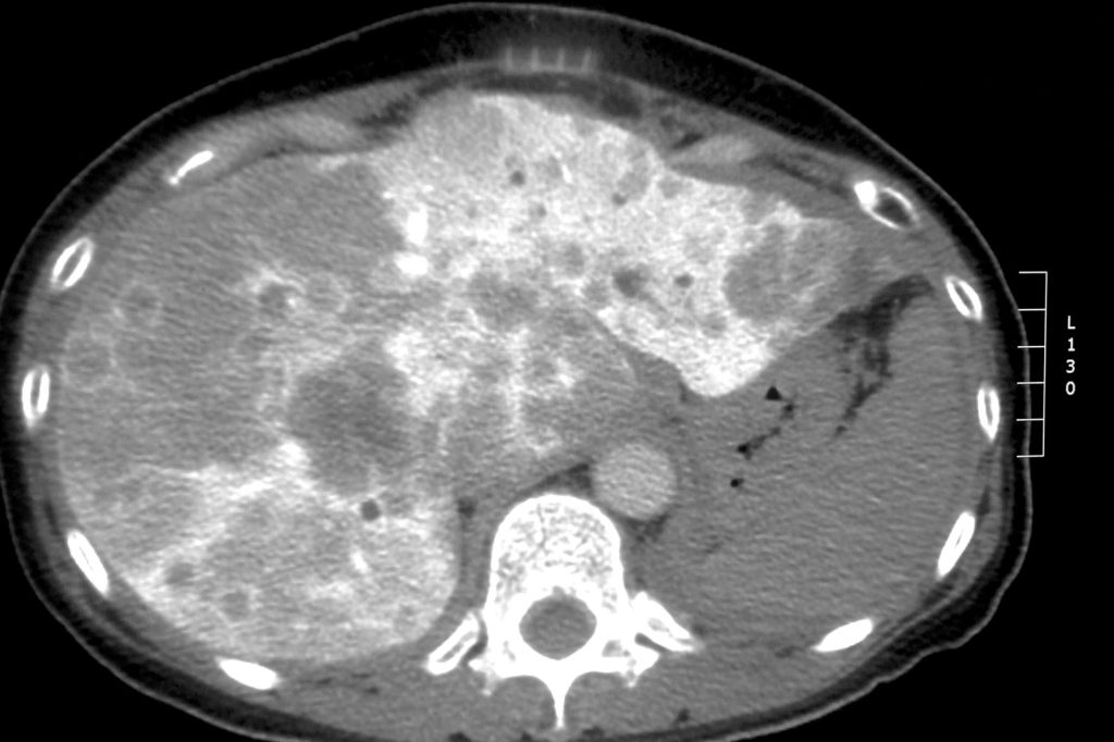 Mindfulness program helps liver cancer patients cope with chemoembolization side effects
