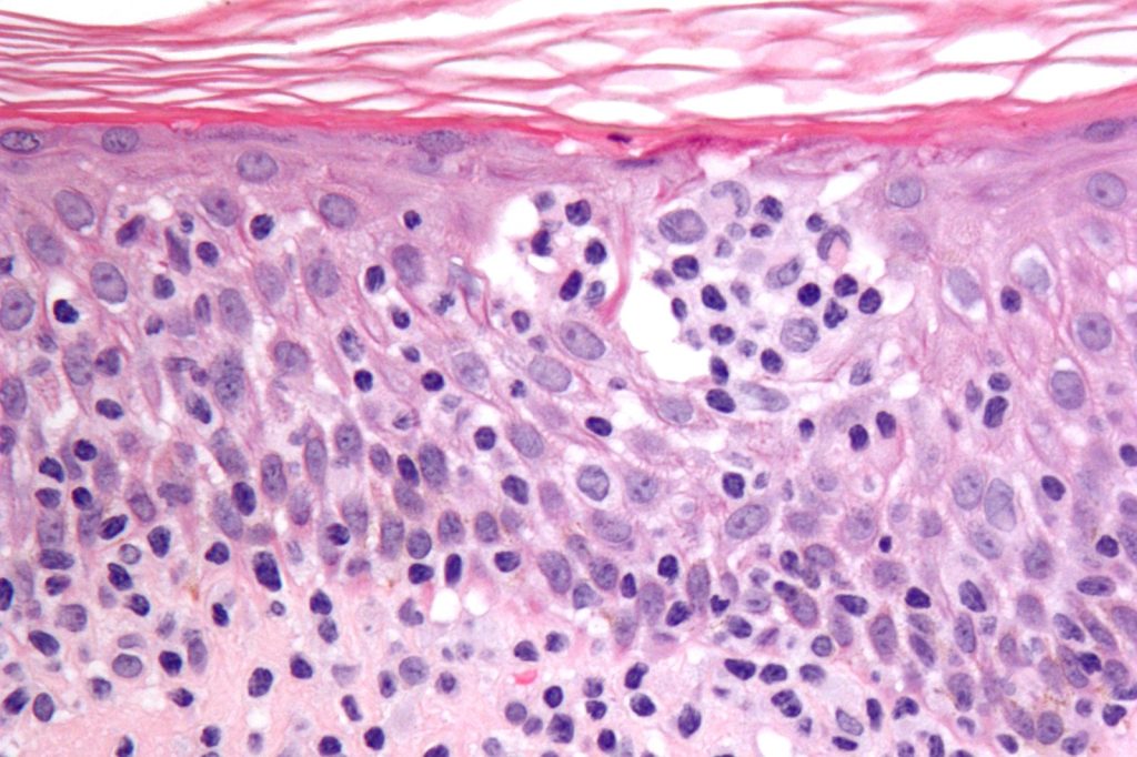 New Analyses Shed Light on Rare Lymphoma Survival Rates