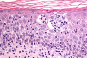 New Analyses Shed Light on Rare Lymphoma Survival Rates