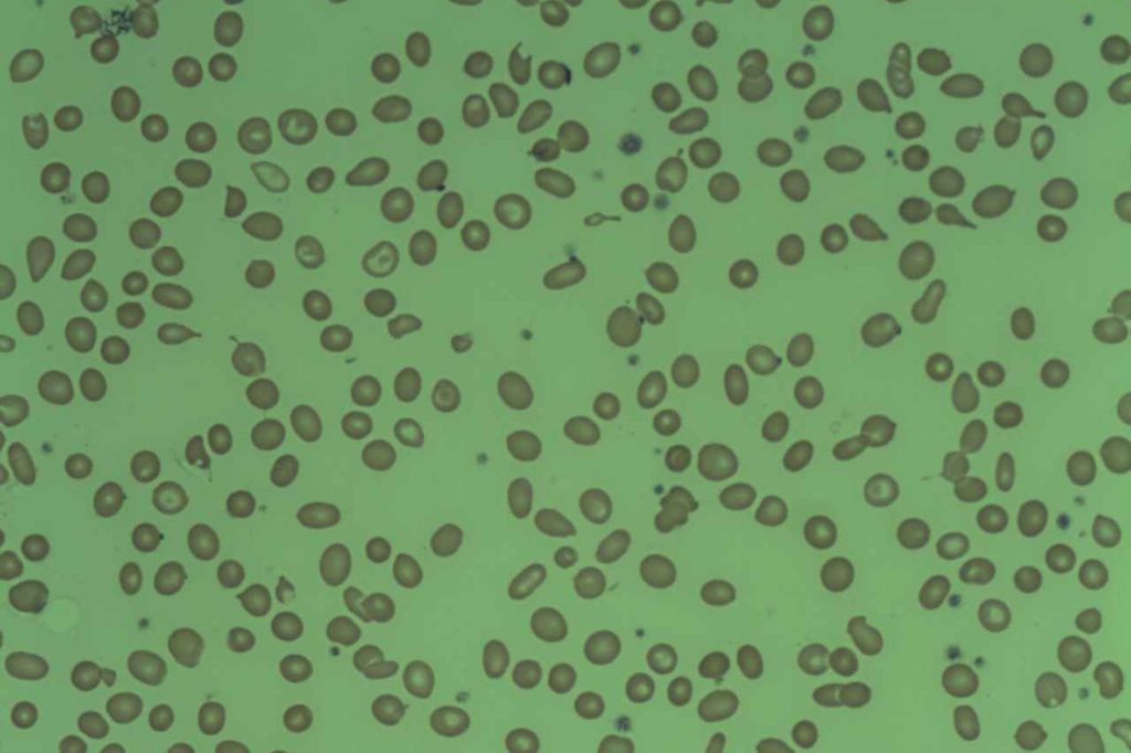 Ipsen acquires Kartos, advancing navtemadlin trial for myelofibrosis patients