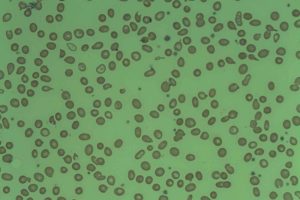 Ipsen acquires Kartos, advancing navtemadlin trial for myelofibrosis patients