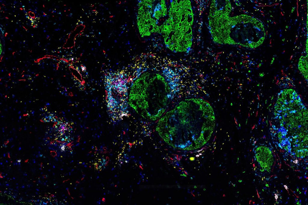 Study: Cell junction genes vary by breast cancer subtype in Asian patients
