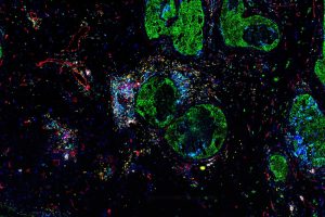Study: Cell junction genes vary by breast cancer subtype in Asian patients
