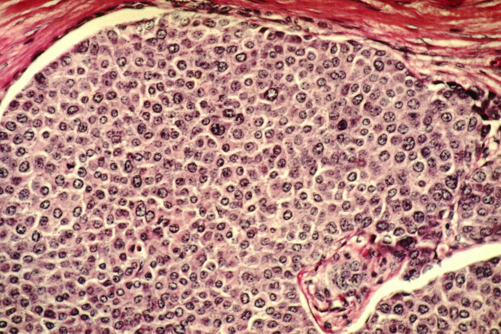 Study Reveals Invisible Cancer Cells Vulnerable to New Immune Attack
