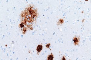 Amyloid-Beta Plaques: How Alzheimer’s Forms and Blood Tests