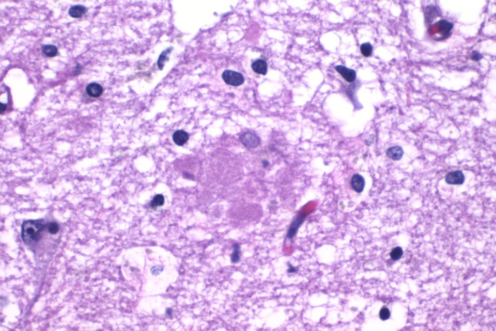 Lecanemab and Donanemab Target Brain Amyloid Plaques