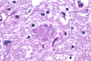 Lecanemab and Donanemab Target Brain Amyloid Plaques