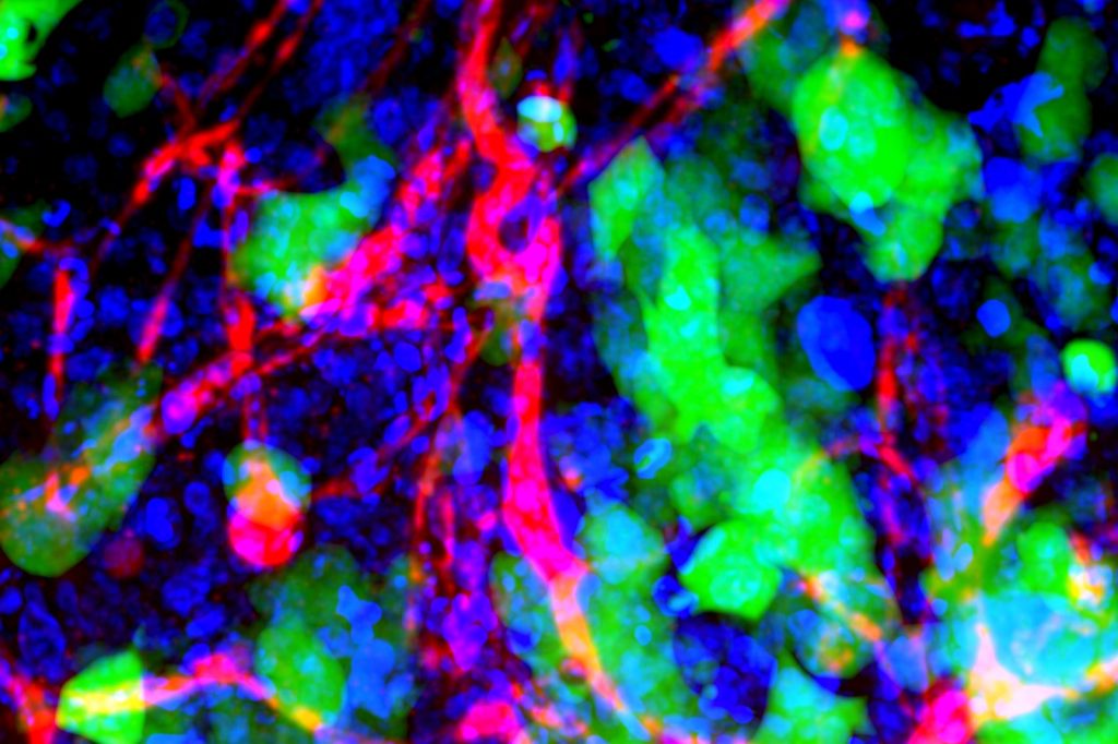 Brain cancers blood-brain barrier blocks most treatments, raising survival concerns