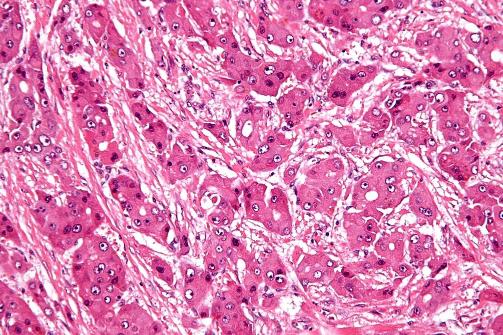 Existing drug could speed new treatment for rare liver cancer