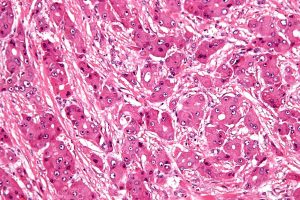 Existing drug could speed new treatment for rare liver cancer