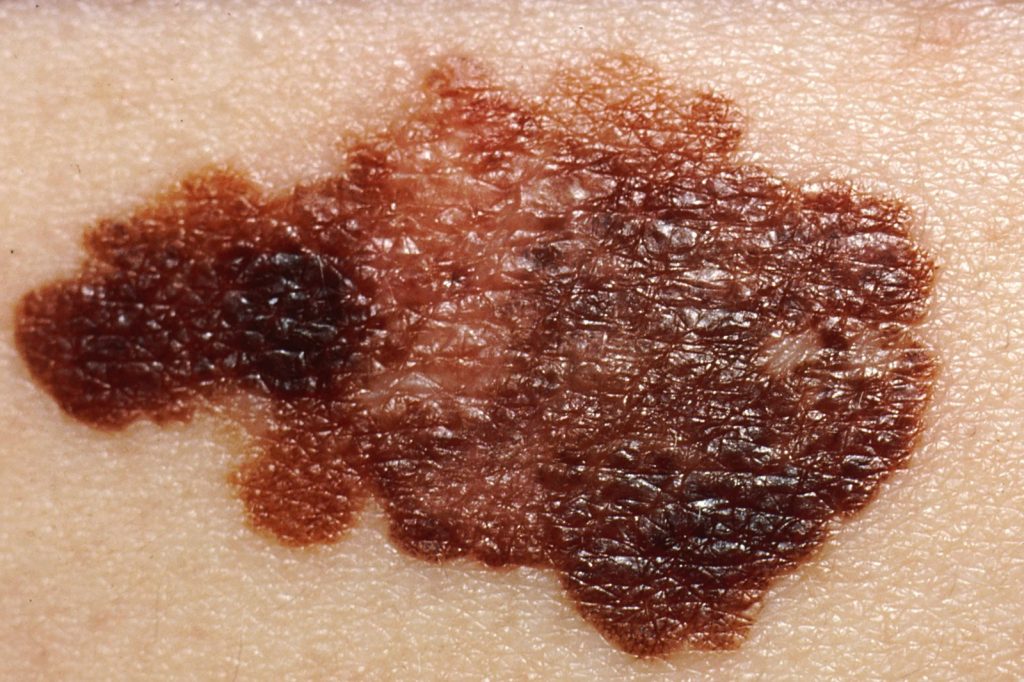 NHS posts melanoma ABCDE checklist on X to aid early detection
