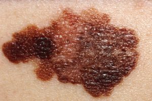 NHS posts melanoma ABCDE checklist on X to aid early detection