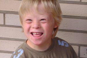 Down Syndrome-Alzheimer’s Link: Chromosome 21’s Role in Amyloid Buildup