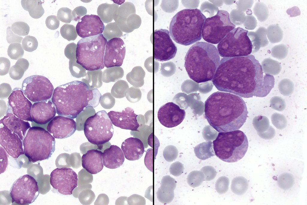 New CAR-T Therapy Shows 83% Remission in Aggressive Blood Cancers