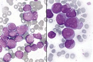 New CAR-T Therapy Shows 83% Remission in Aggressive Blood Cancers