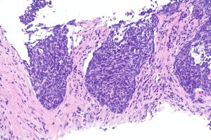 Precision medicine drives non-small cell lung cancer treatment market growth to 2036
