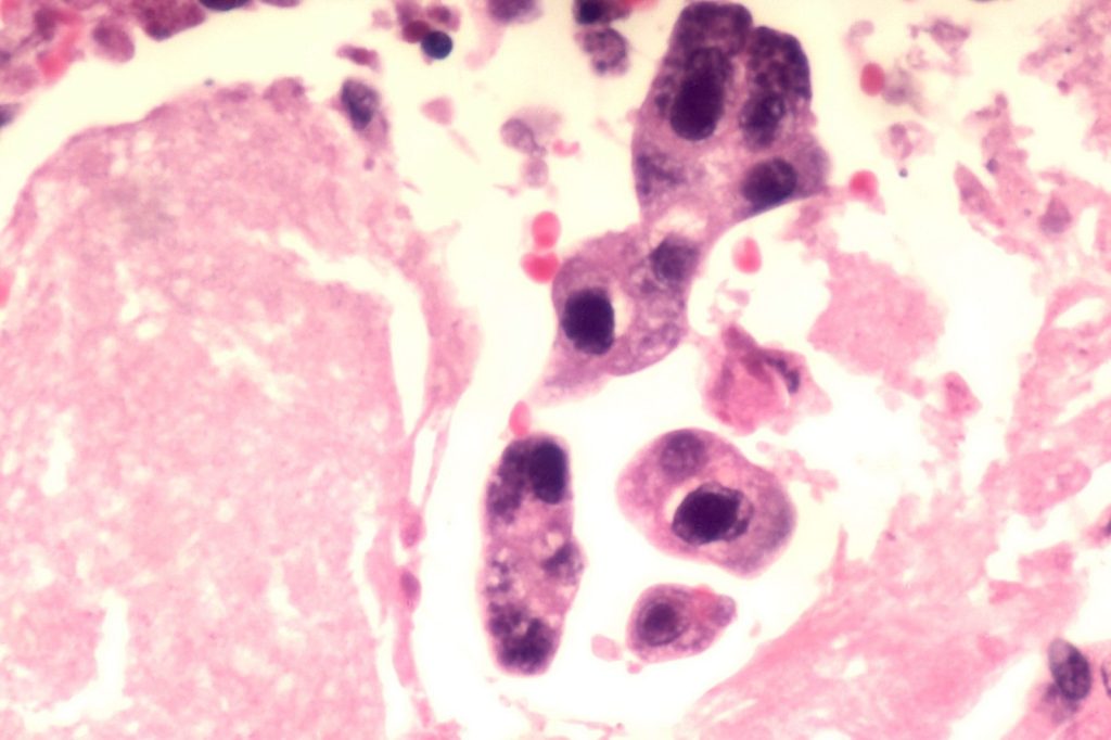 Coinfection Involves Multiple Pathogens Interacting Within Host