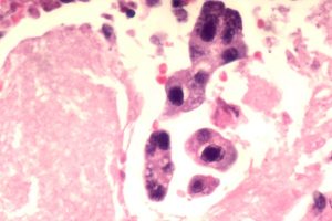Coinfection Involves Multiple Pathogens Interacting Within Host