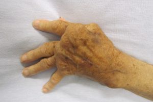 Autoimmune Disorders Vary Widely, Pose Diagnostic Challenges
