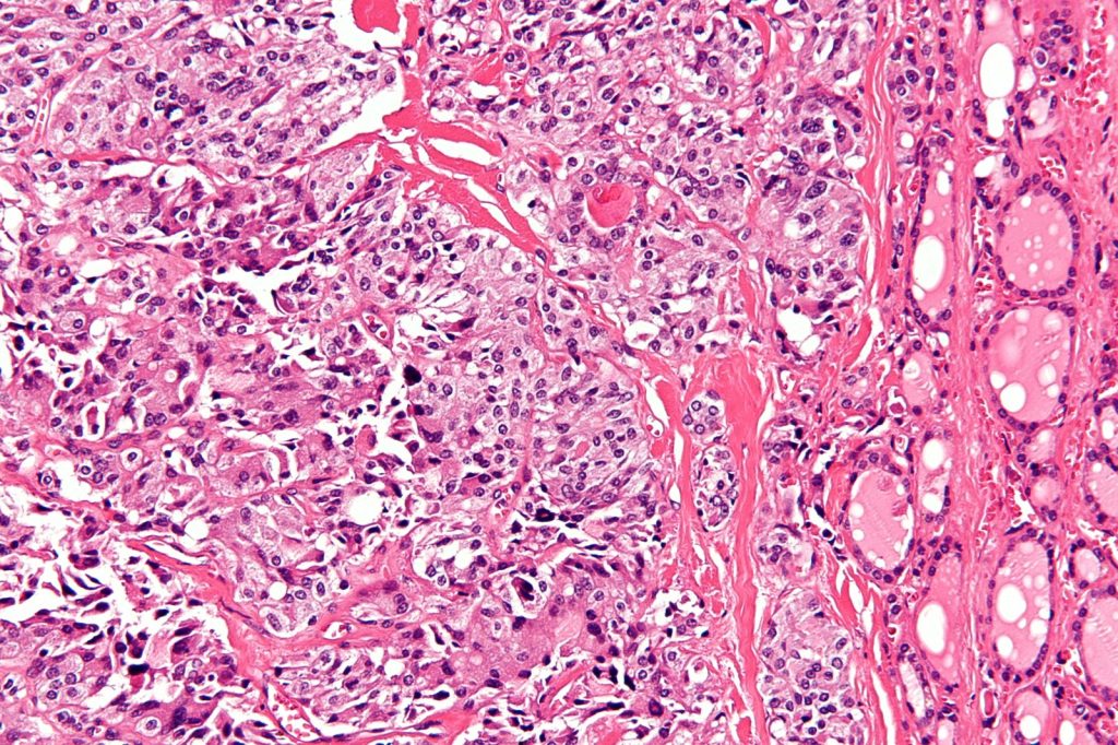 Rare thyroid cancers biology and inherited risks uncovered