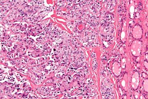 Rare thyroid cancer’s biology and inherited risks uncovered